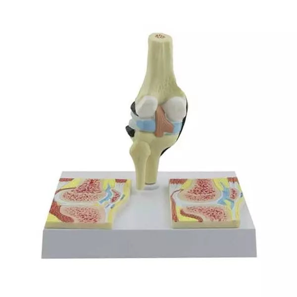 Kolenný kĺb s reumatoidnými štádiami